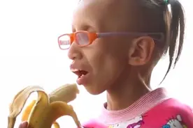 14岁女孩拥有80岁“奶奶脸”，一年老10岁，父母为救女儿生下二胎图片