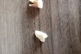 拔牙原来不是个大事图片