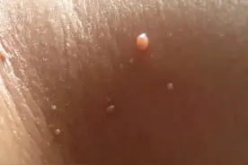 脖子和腋下的“小肉粒”是啥？影响身体健康吗？医生建议引起重视图片