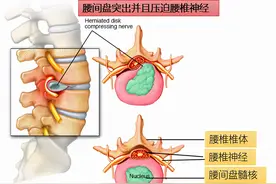 腰臀部疼或下肢麻木，是腰椎间盘突出吗？9种疾病需鉴别图片