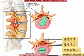 腰臀部疼或下肢麻木，是腰椎间盘突出吗？9种疾病需鉴别图片