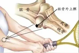 说说网球肘图片