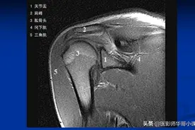 肩关节+外展外旋位（ABER）磁共振（MRI）解剖--精品图集图片