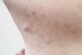 若发现脖子上有肉疙瘩“冒出”，不要忽视了，或许它在“提示”你图片