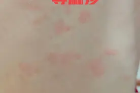 4种常见的皮肤病，教你最实用的识别和处理方法图片