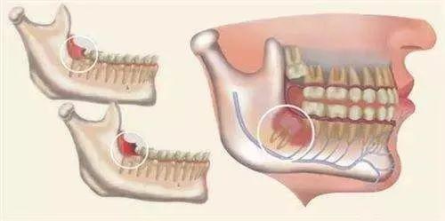 角化囊肿发展迅速