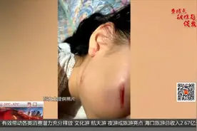 女孩脸被健身器材划伤，家长质疑安全隐患，“已经不是第一次了！”图片