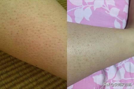 脸上皮肤呈鸡皮