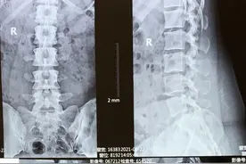 27岁女性，两间隙腰椎间盘突出症，6颗钉子，4个融合器图片