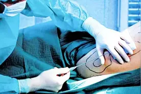 医美乱象：抽脂减肥 有人塑形有人送命图片