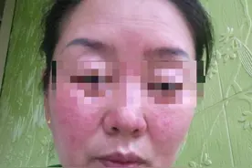 激素脸红肿痒可以修复好吗？激素皮炎如何修复？图片