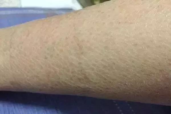 鱼鳞病流汗吗 鱼鳞病流汗吗