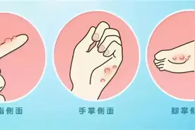 痒痒痒！你被汗疱疹“盯”上了吗？图片