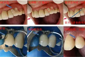 补牙和根管治疗是一个骗局？图片