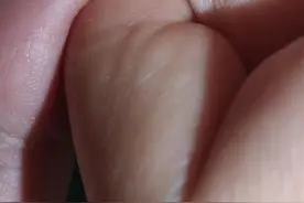 手上长了个疙瘩图片