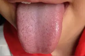 真实病案 | 七岁小孩，咳嗽，大便干，从小输液很多，经常生病图片