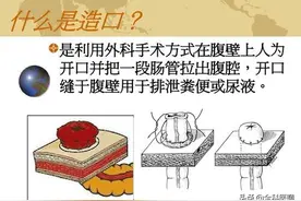 肠道造瘘者，改造的肛门，改变的人生，选择了生存，放弃了生活。图片