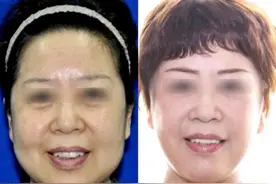 57岁再婚！为了爱情变美，这几个项目做完她年轻了十岁图片