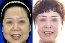 57岁再婚！为了爱情变美，这几个项目做完她年轻了十岁图片