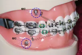 牙齿矫正一般是什么时候打骨钉？矫正是不是必须打骨钉？图片