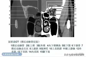 正常眼眶的CT解剖图片