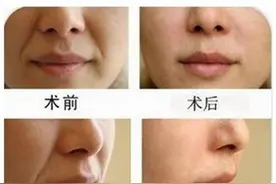 听医生说：法令纹要这样才能去掉图片