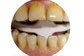 牙齿发黄是什么原因导致的？怎么才能让牙齿变白？牙科医生告诉你图片