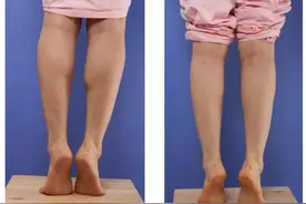 肌肉腿很苦恼？别努力错了，详细解说肌肉腿脂肪腿区别和解决图片