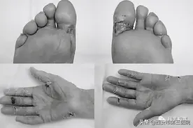 【专家解读】乳腺癌化疗后并发症——手足综合征图片