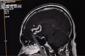 男子拔牙竟造成脑部感染发脓，拔牙的这些忠告，每个人都应该知道图片