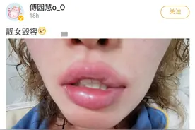 25岁傅园慧自曝毁容，嘴巴肿成香肠闭不上，胸前一片红肿太吓人图片