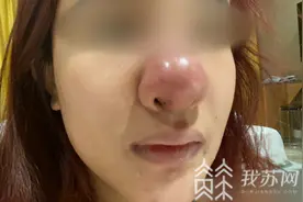 女孩“猪鼻子”照满天飞，她是被毁容了吗？图片