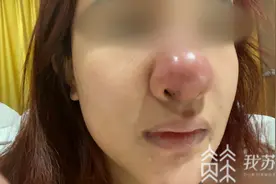 女孩“猪鼻子”照满天飞，她是被毁容了吗？图片