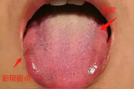 舌象是内脏一面镜子，舌上3个迹象看出你有湿气、瘀血、阴虚图片