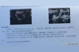 凌晨三点，急性卵巢囊肿破裂图片