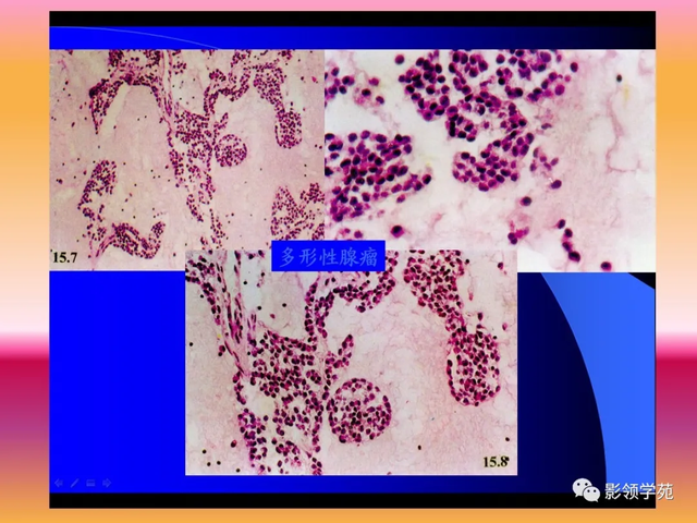 腮腺角化型鳞癌