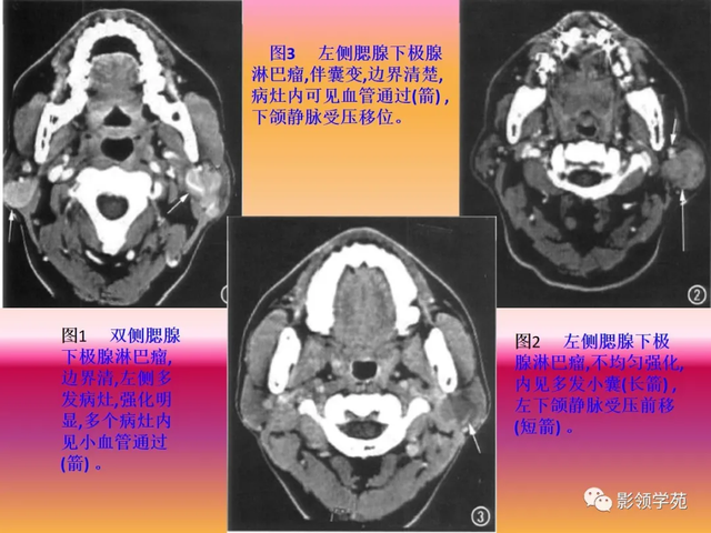 腮腺角化型鳞癌