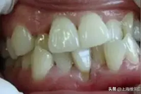 你真的了解自己的牙齿？我国90%成年人患牙周炎图片