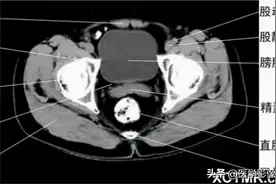 胸、腹、盆腔 CT断层解剖图片