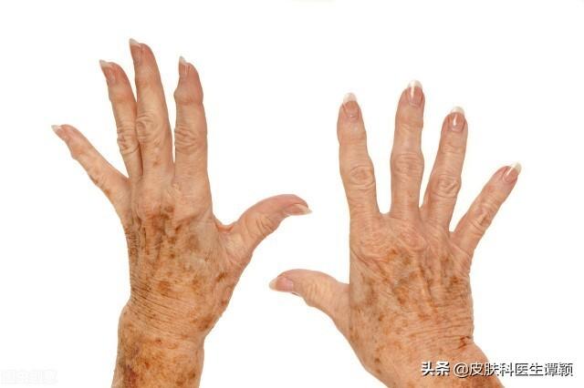 躯干肿块脂溢性角化病