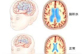 医生，您给我诊断脑积水是因为下雨或是游泳脑子里进“水”了么？图片