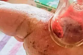 解决痛风的小方法图片