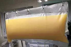 小时候爱吃炸鸡汉堡，长大了爱喝啤酒吃外卖，33岁男子切胃减重前抽出2升“油浆”图片