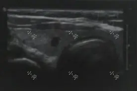 女白领体检查出甲状腺结节，没想到是甲状腺癌伴淋巴转移图片