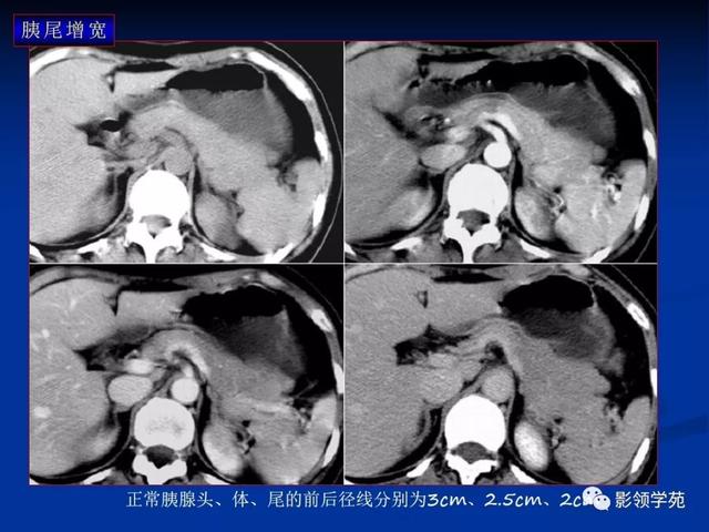 胰腺的解剖与常见变异
