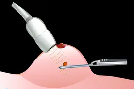 乳房肿块手术是选择微创好？还是选择开放好？两者有何差别？图片