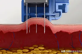 打过“水光针”的人，谈一谈自己的真实感受图片