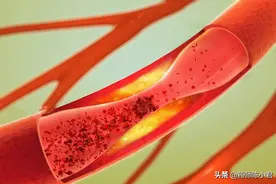血栓，就像游走在血管里的幽灵！它竟然最怕这5个小动作！图片