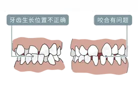 为什么只要戴牙套，牙齿就可以恢复得很整齐？生动展示矫正过程图片