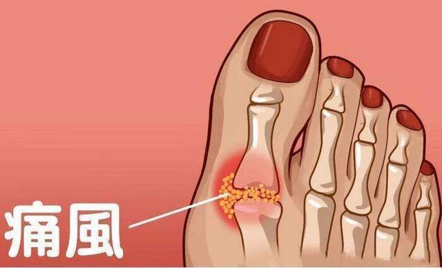 夏天痛风“高发期”，这2物大胆吃，尿酸一天天降下来